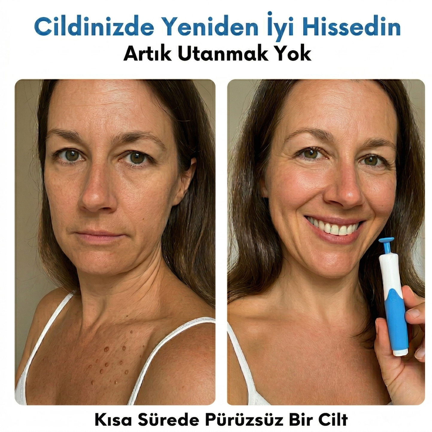 DermoTag™ Profesyonel Et Beni Giderici Kit