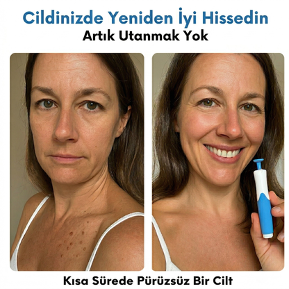 DermoTag™ Profesyonel Et Beni Giderici Kit
